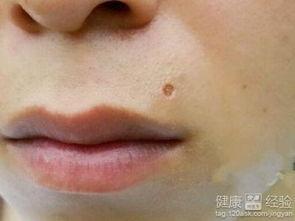 给吃瓜男孩点痣视频,颜值飙升！